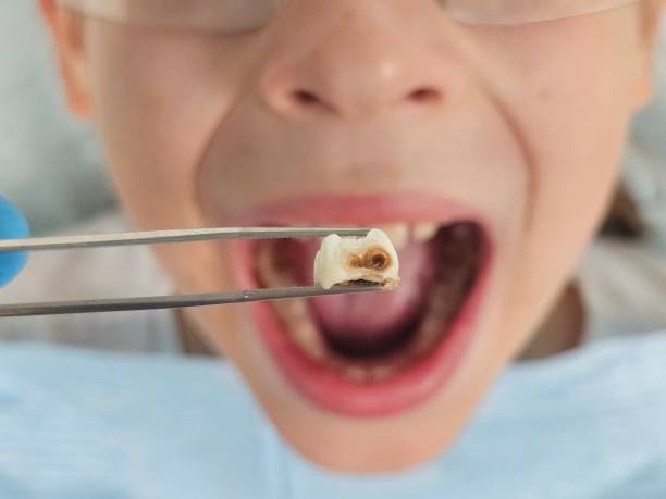 Best Emergency Tooth Extraction in South Alamo, TX