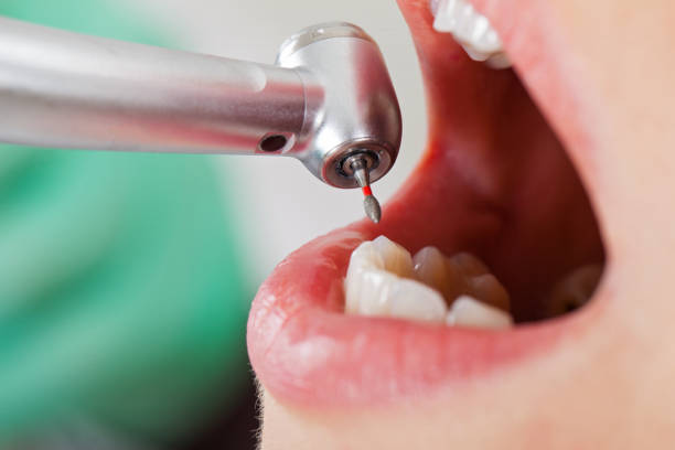 Best Urgent Care for Lost Fillings or Crowns in South Alamo, TX